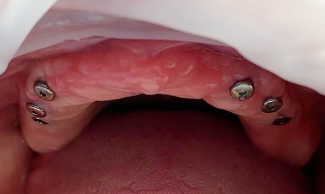 Implantology 1 LV before
