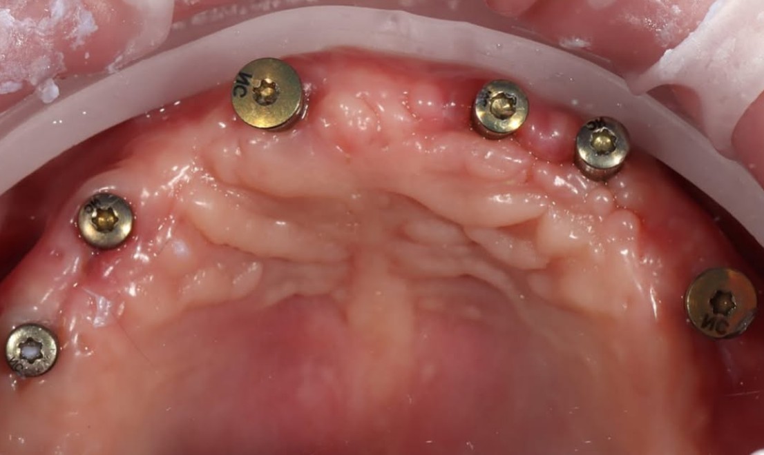 Implantology 2 LV before
