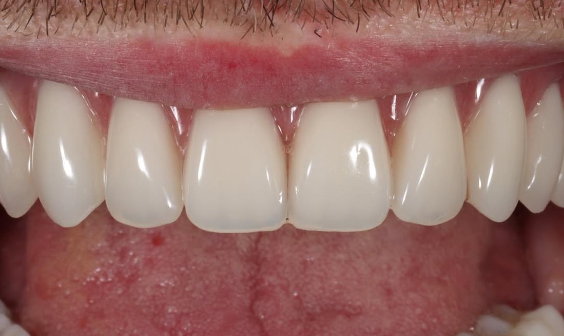 Implantology 2 LV after