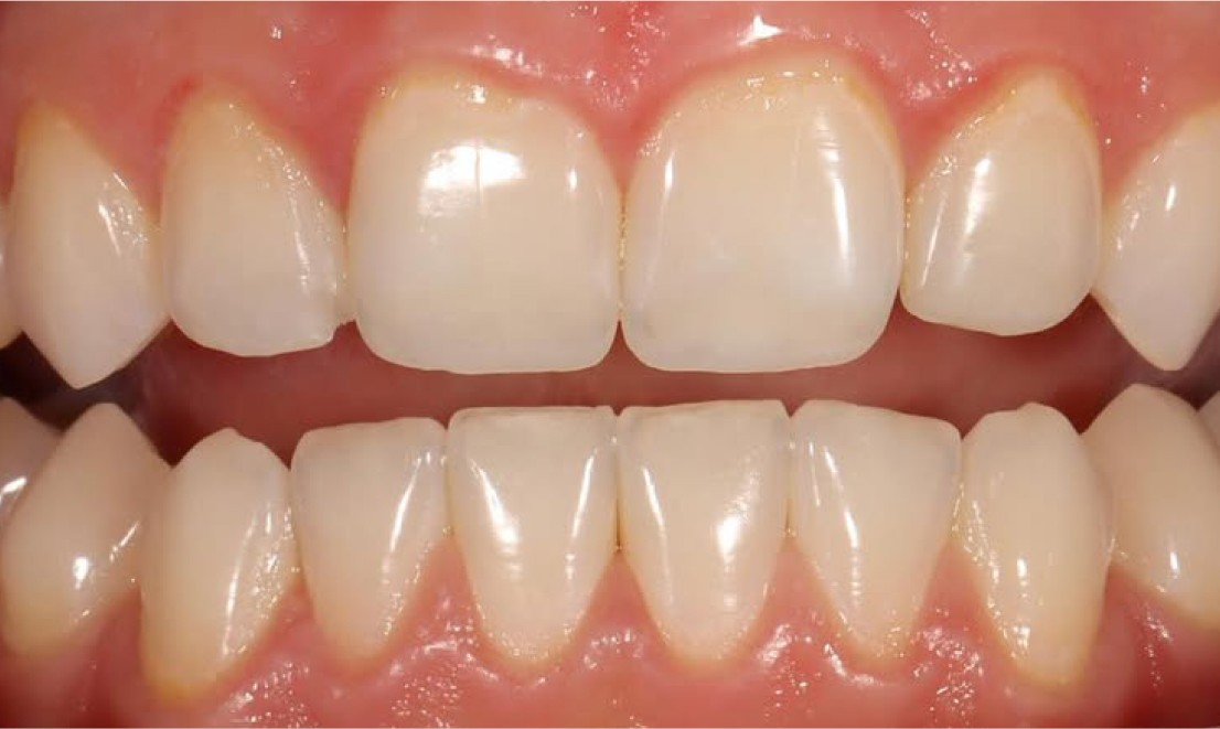 Teeth Whitening 1 LV before