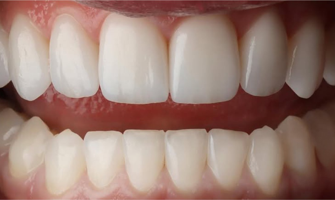 Teeth Whitening 1 LV after