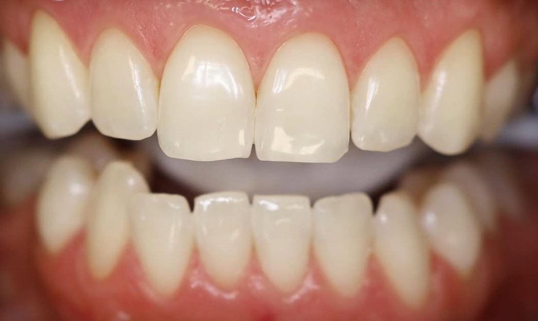 Teeth Whitening 2 LV after