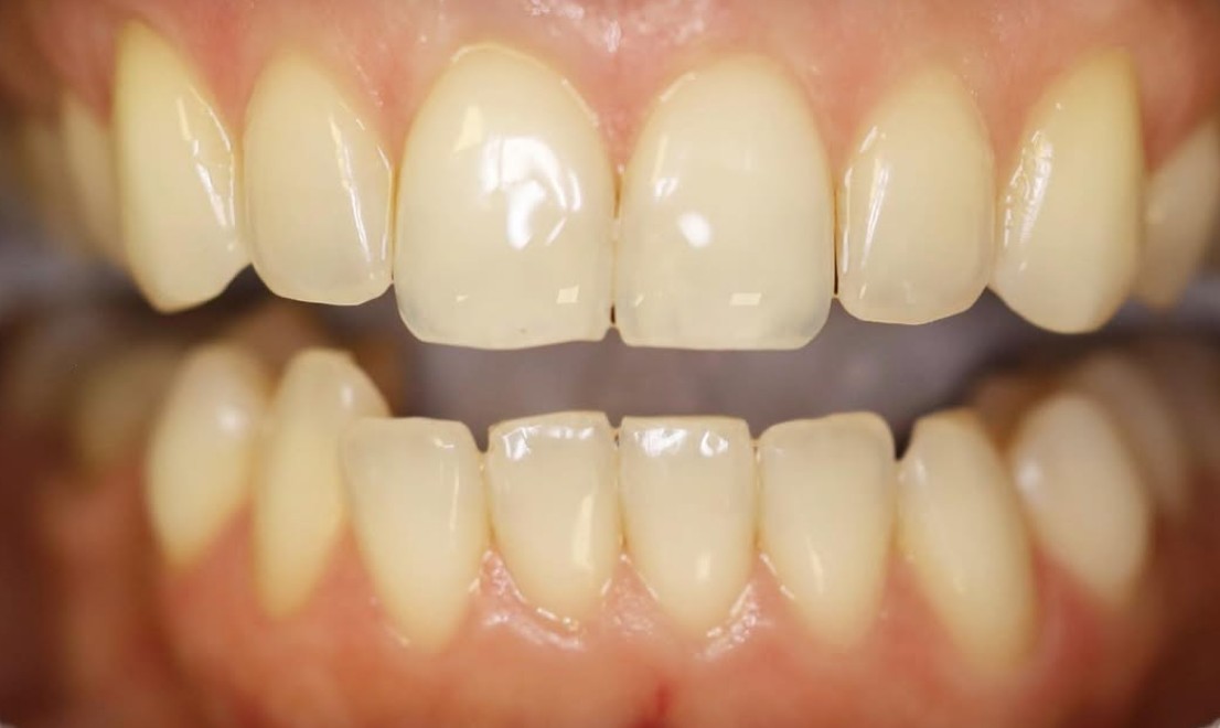 Teeth Whitening 2 LV before
