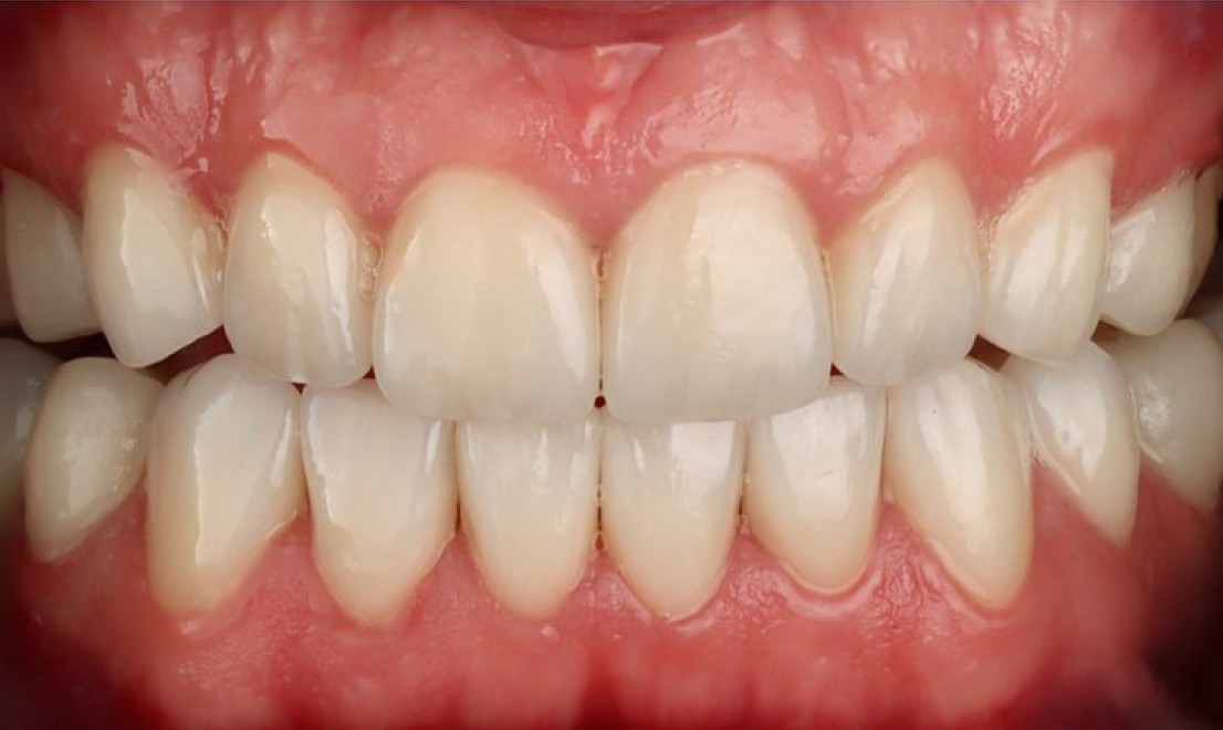 Veneers 1 LV after