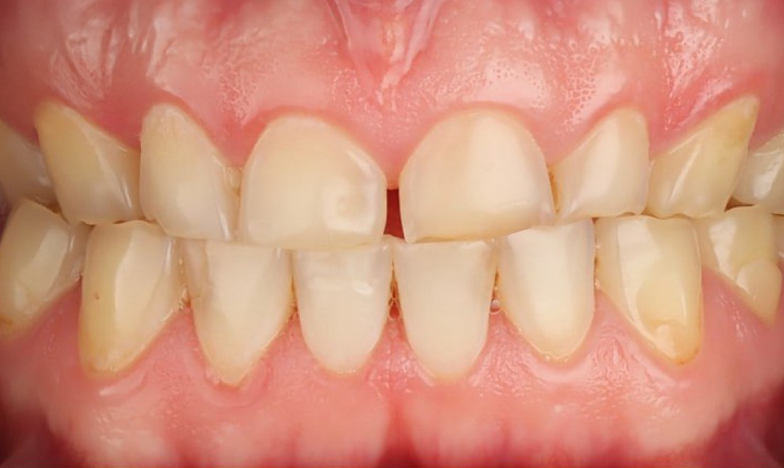 Veneers 1 LV before