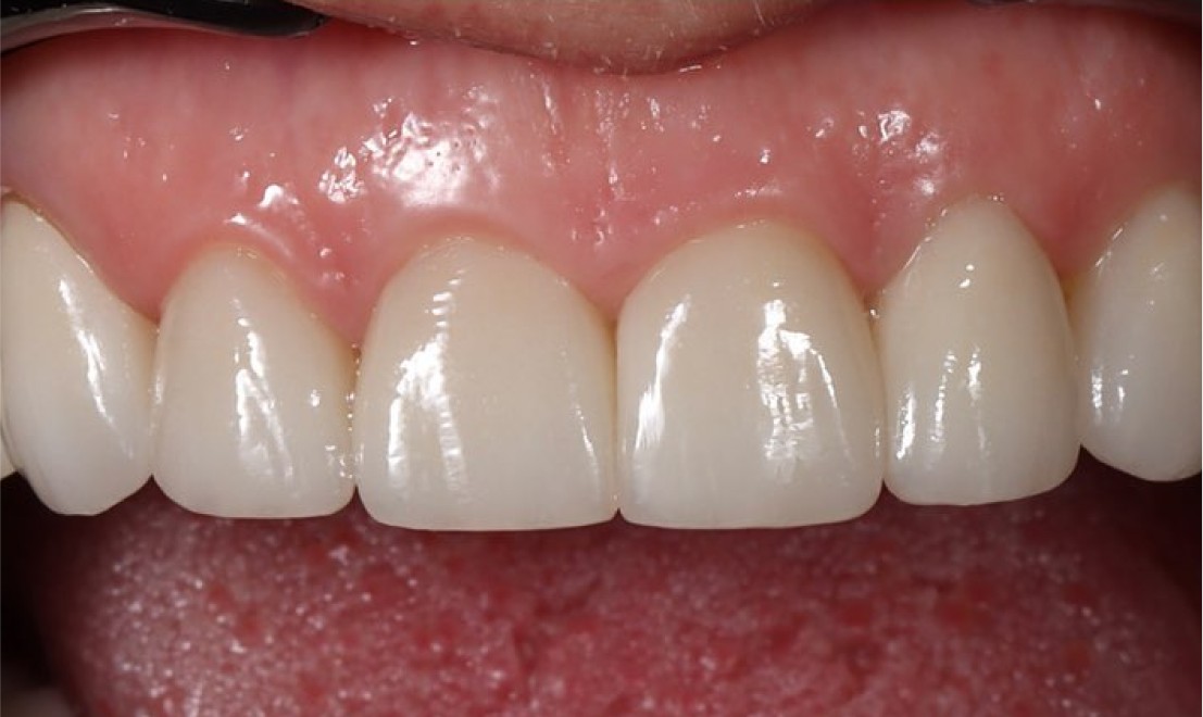 Veneers 2 LV after
