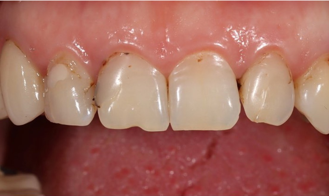 Veneers 2 LV before