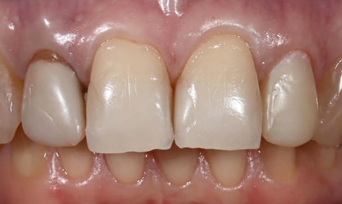 Veneers 4 RU before