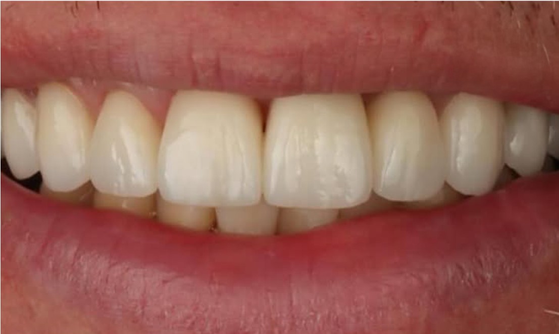 Veneers 7 RU after