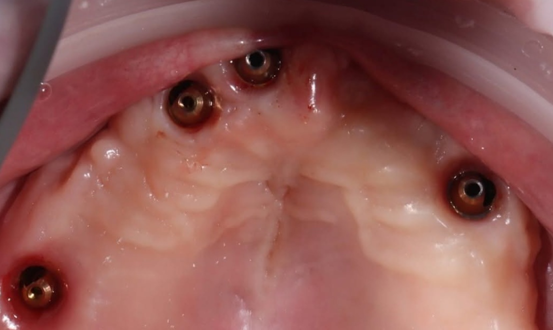 Implantology 3 LV before