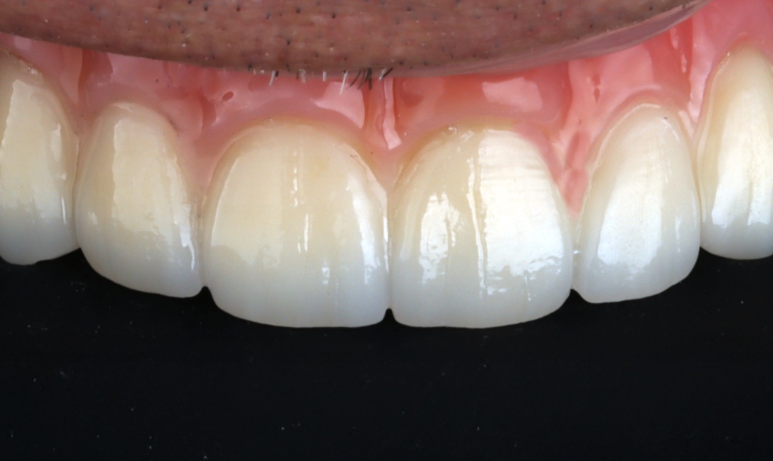 Implantology 3 LV after