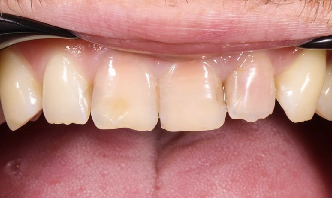 Veneers 10 LV before