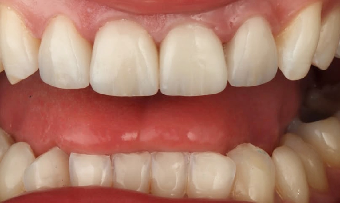 Veneers 10 LV after