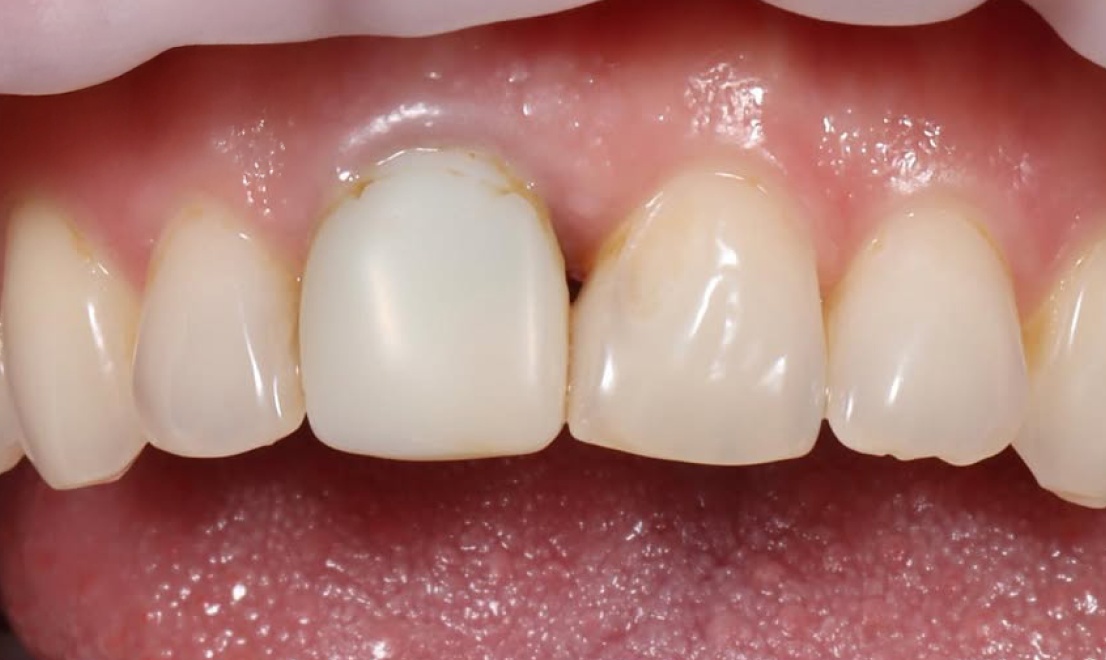 Veneers 11 LV before