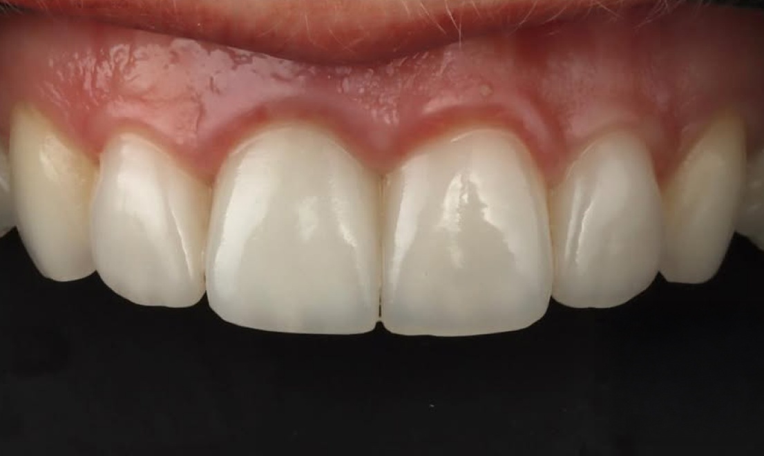 Veneers 11 LV after