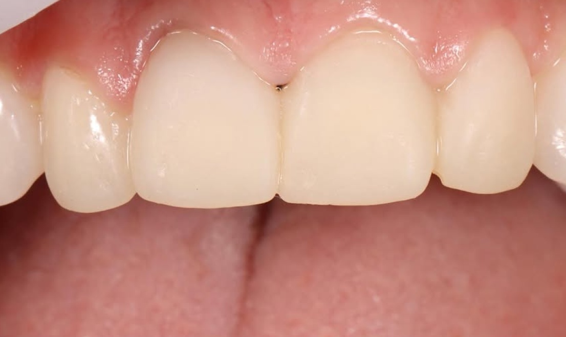 Veneers 12 LV before