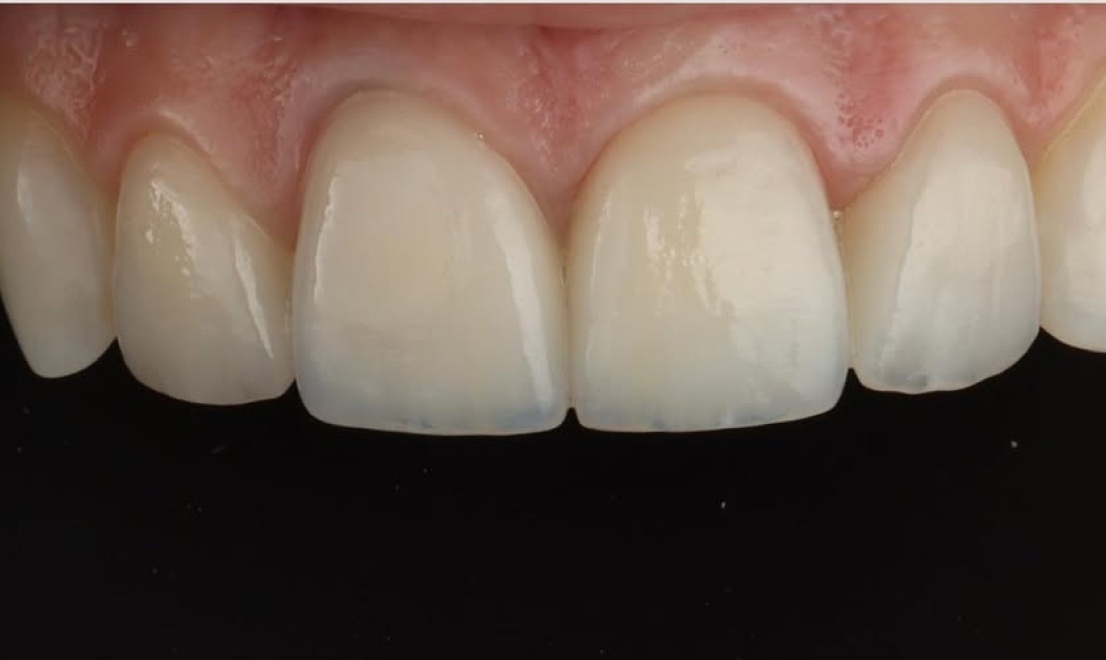 Veneers 12 LV after