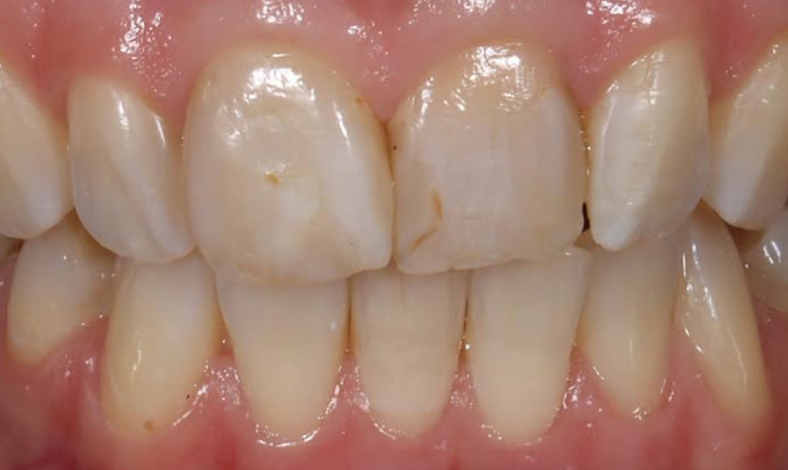 Veneers 13 LV before
