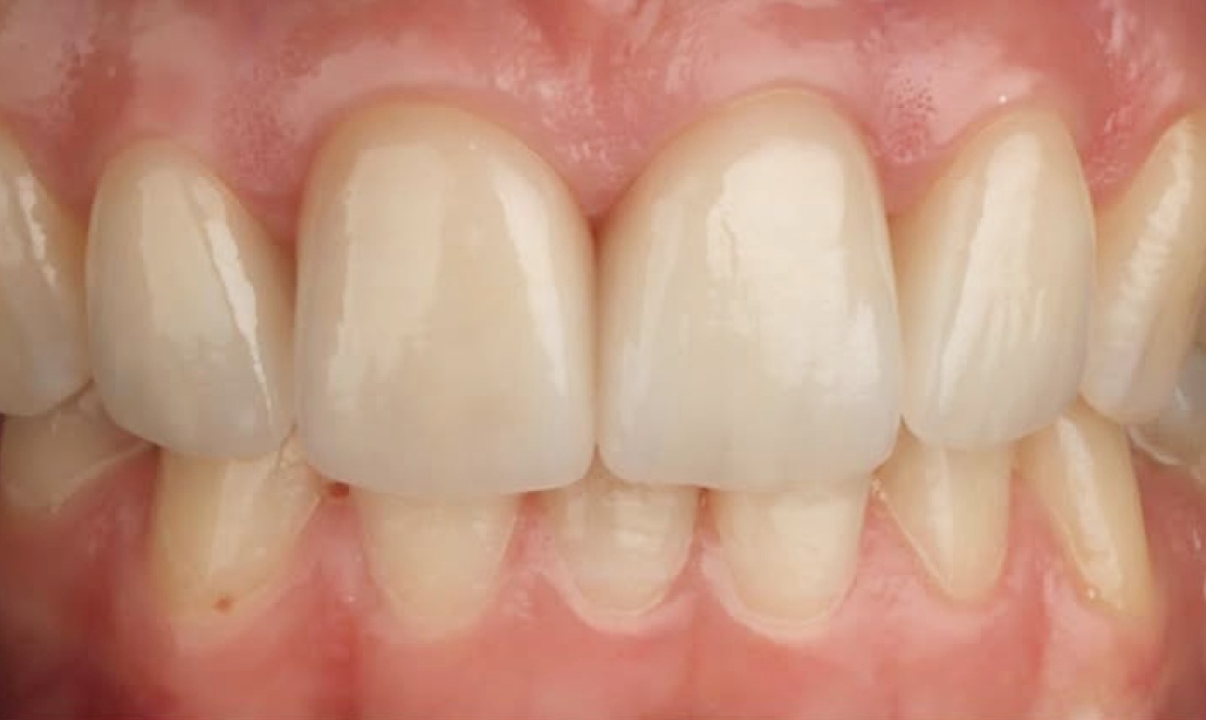 Veneers 13 LV after
