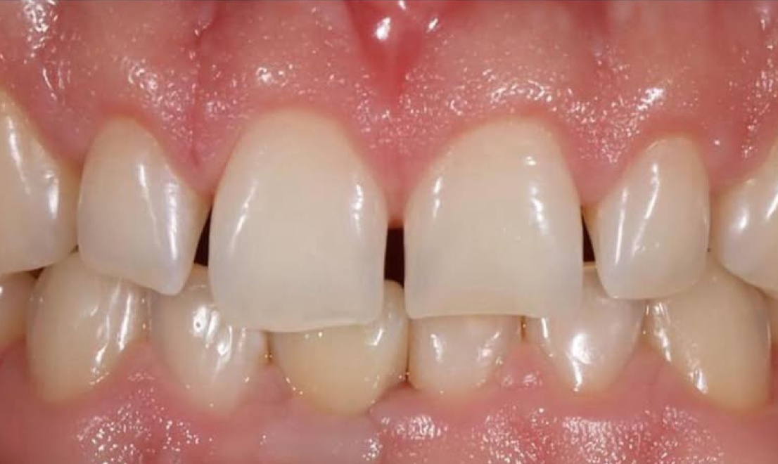 Veneers 14 LV before