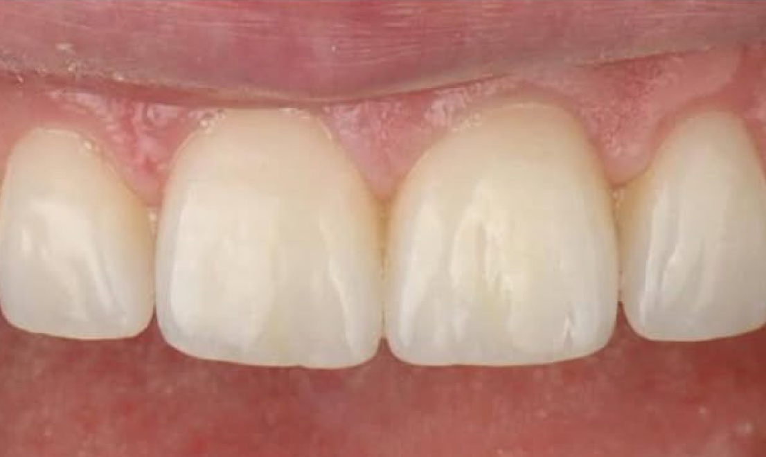 Veneers 14 LV after