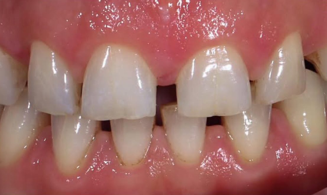 Veneers 15 LV before