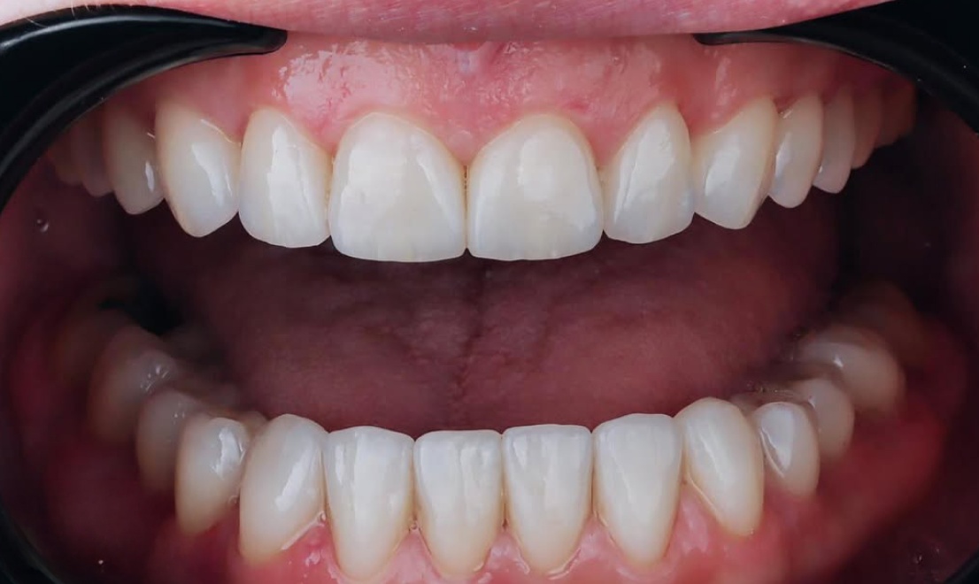 Veneers 15 LV after