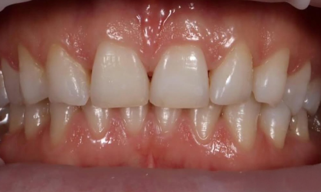 Veneers 16 LV before