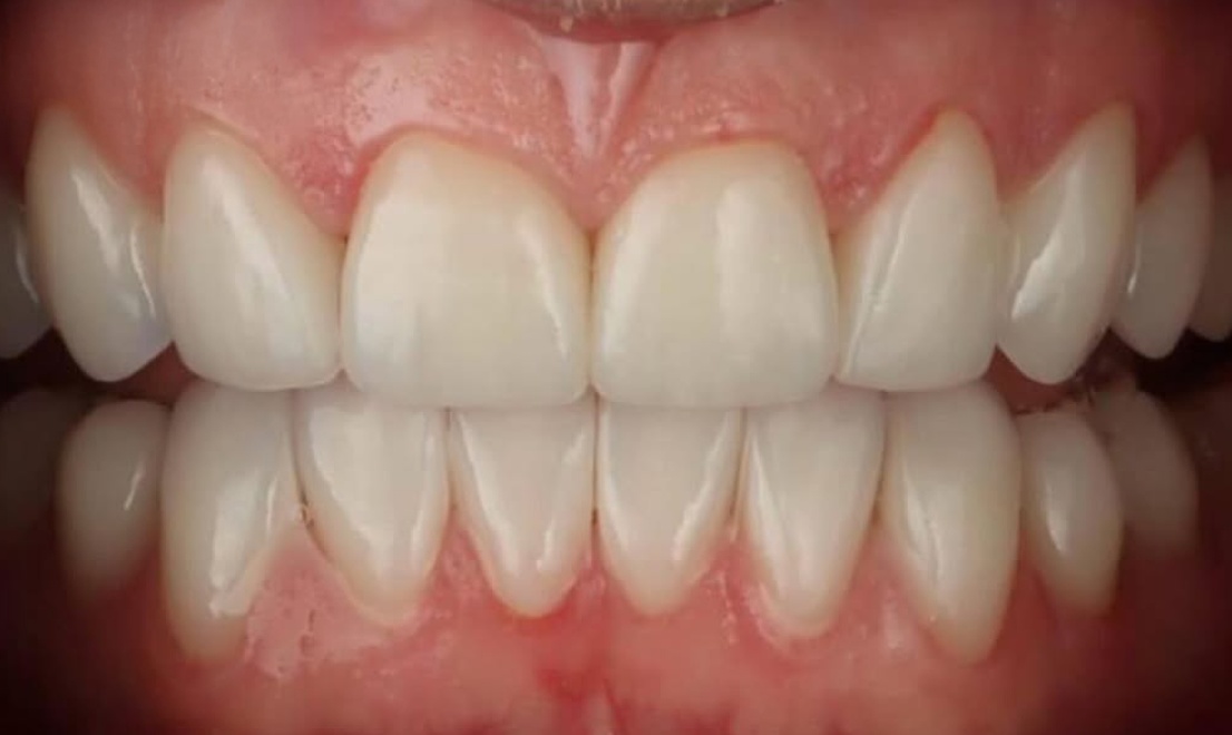 Veneers 16 LV after