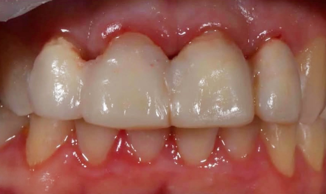 Veneers 8 LV before