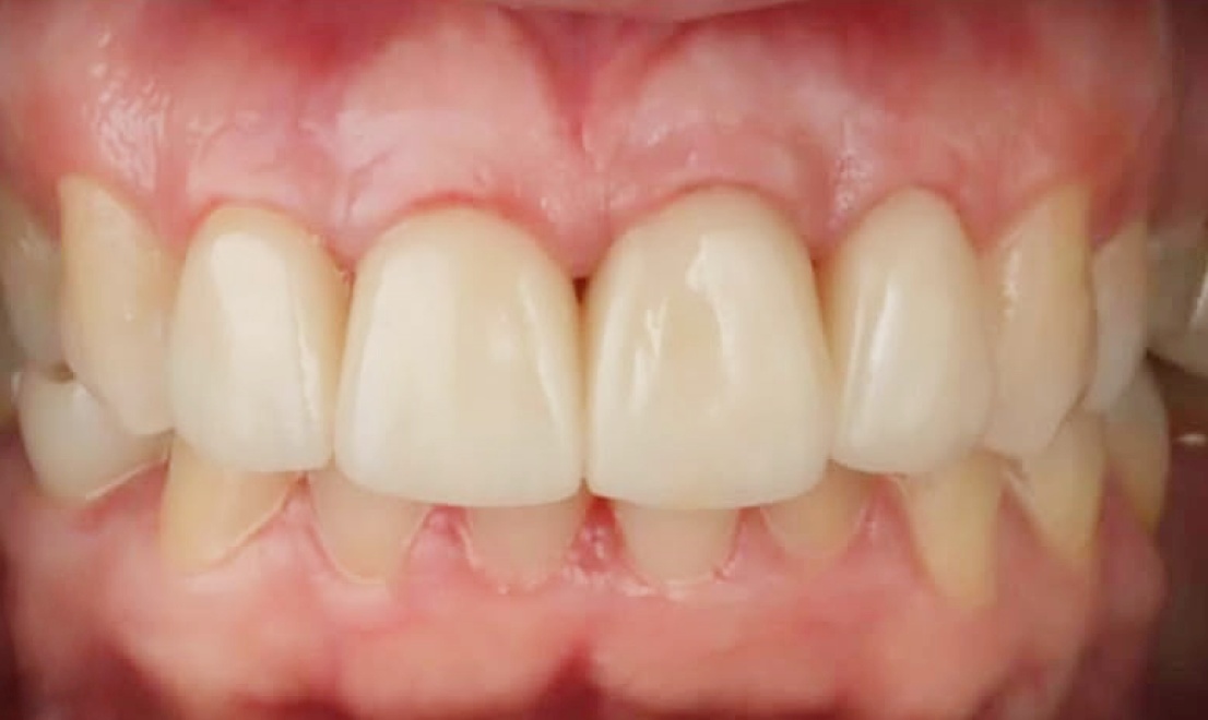 Veneers 8 LV after