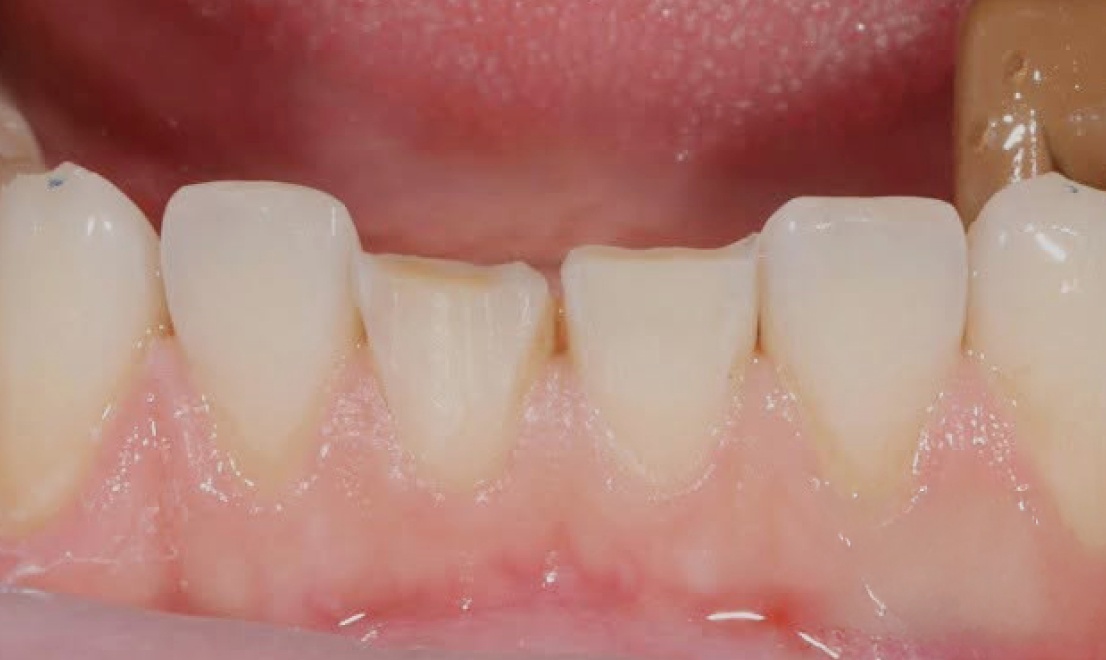 Veneers 9 LV before