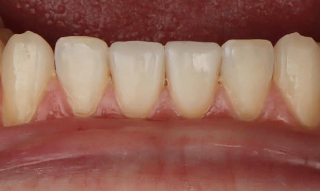 Veneers 9 LV after